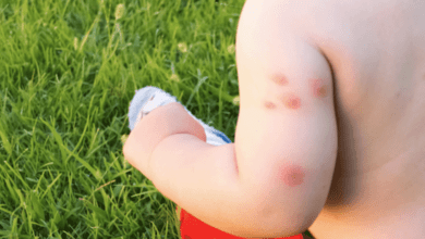 Bed Bug Bite Progression: From Initial Bite to Healing