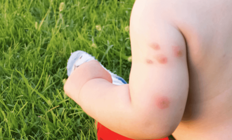 Bed Bug Bite Progression: From Initial Bite to Healing